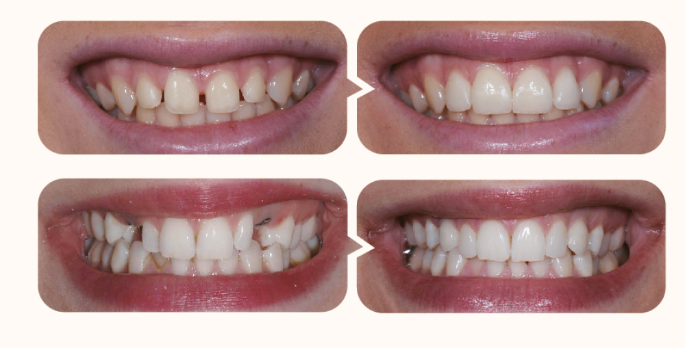 mlx-teeth